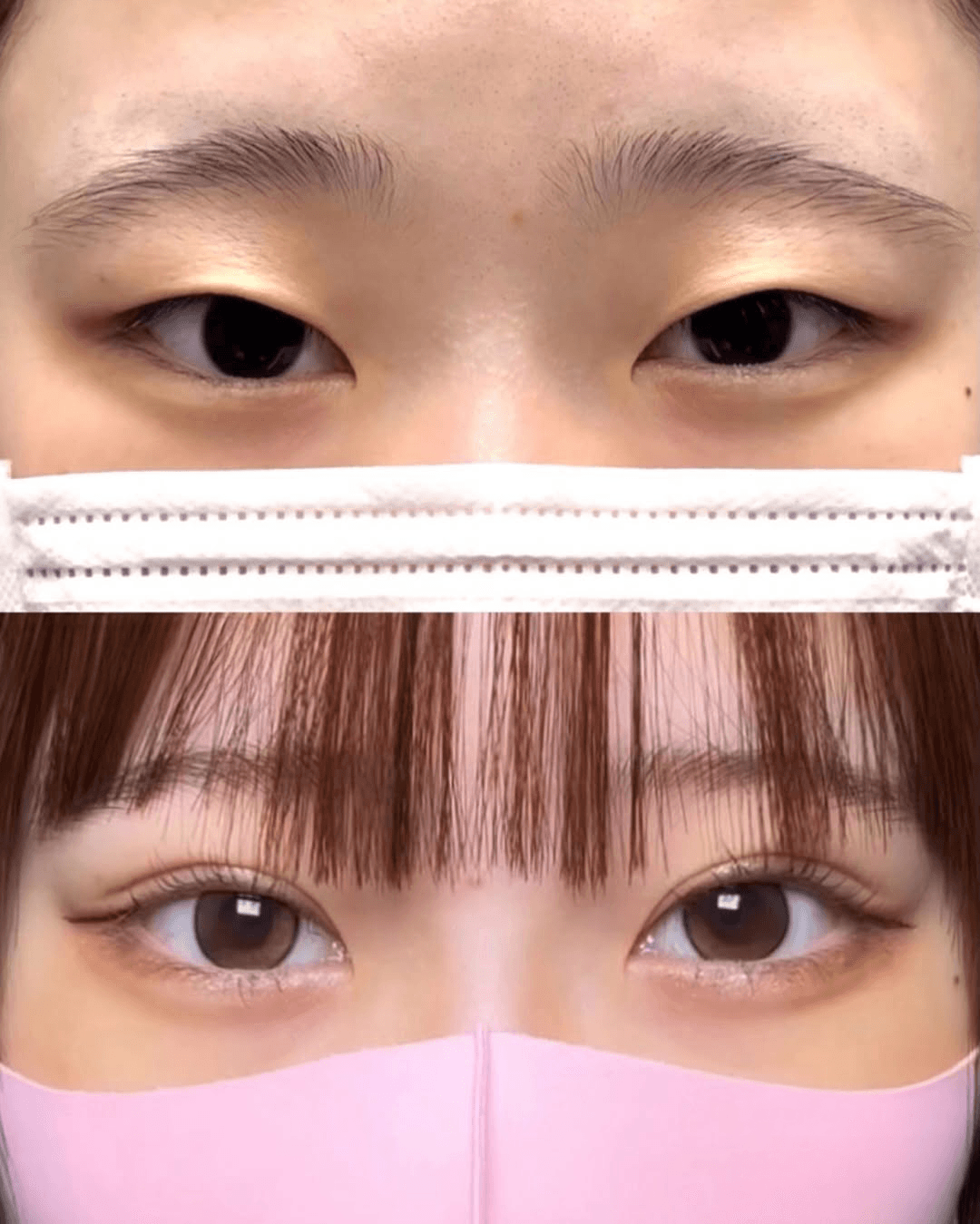 Double eyelid case 1 before and after